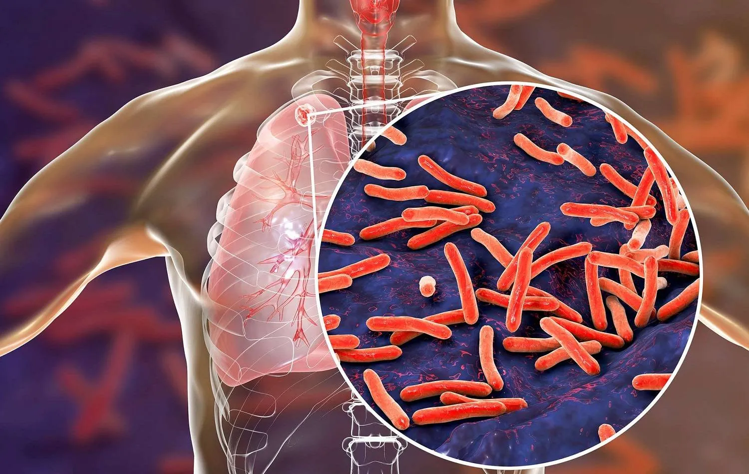 طريقة مبتكرة لعلاج مرض السل