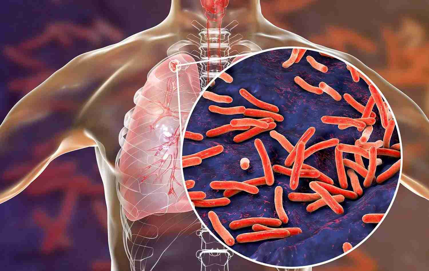 طريقة مبتكرة لعلاج مرض السل